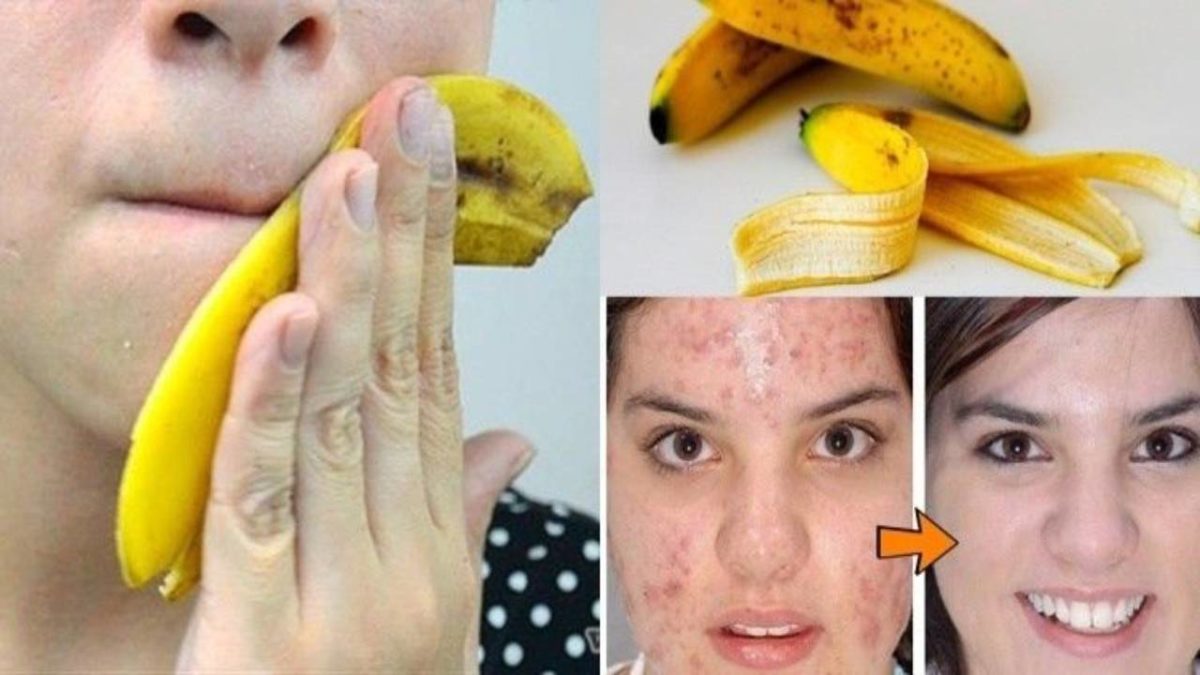 Bananas for acne – Properties, Benefits of banana peels for your skin