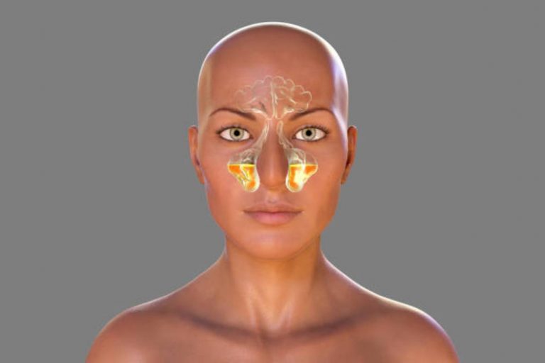 Chronic Rhinosinusitis Explained