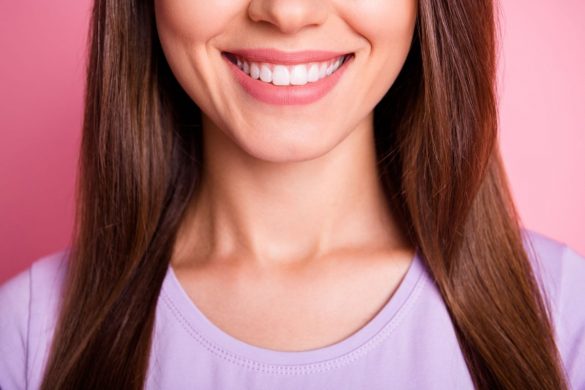 Do Porcelain Veneers Stain