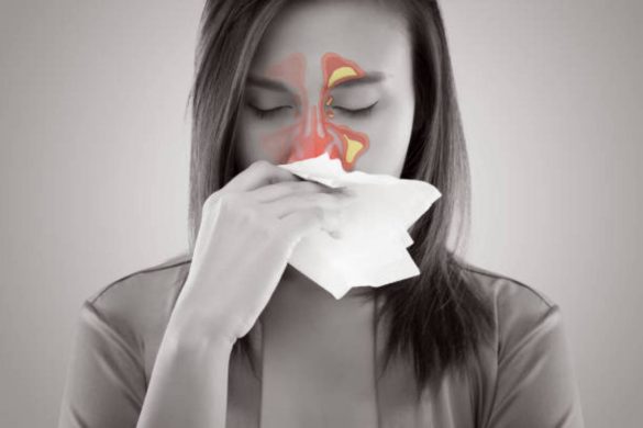 Sinus Infections