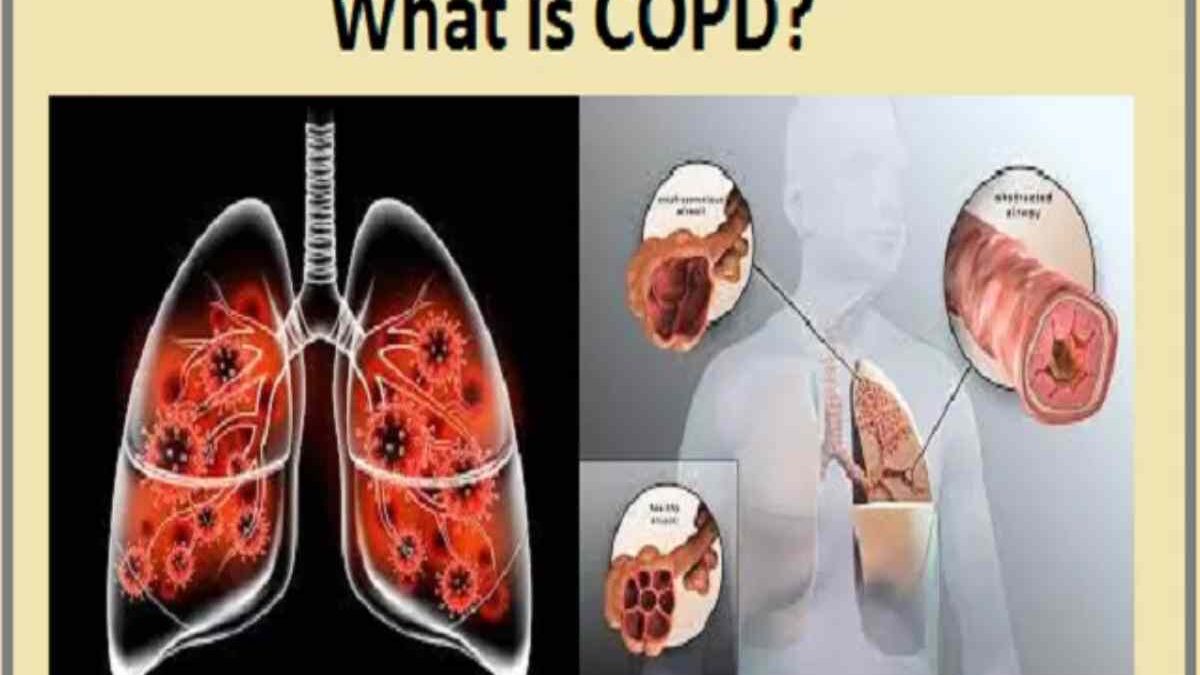 Is COPD Contagious? A Complete Guide