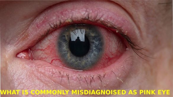 What is Commonly Misdiagnosed as Pink Eye