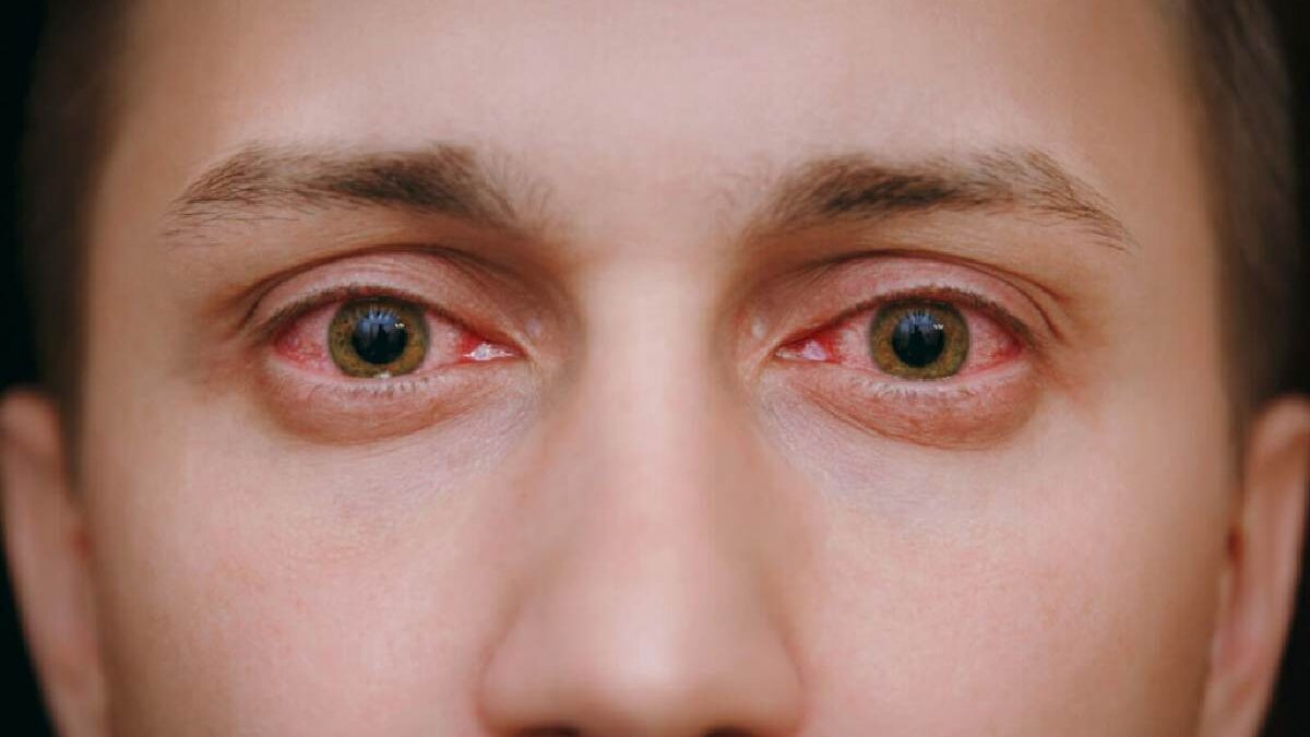 What is Commonly Misdiagnosed as Pink Eye?