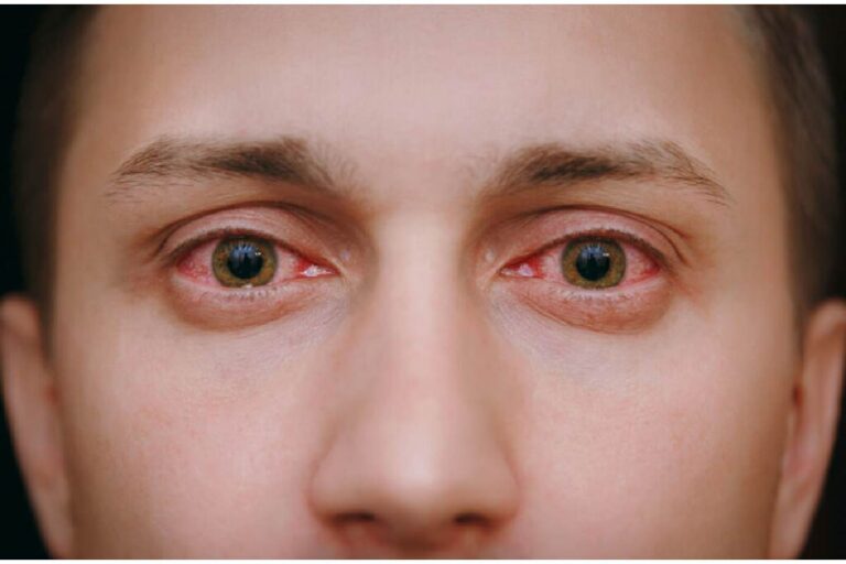 What is Commonly Misdiagnosed as Pink Eye?