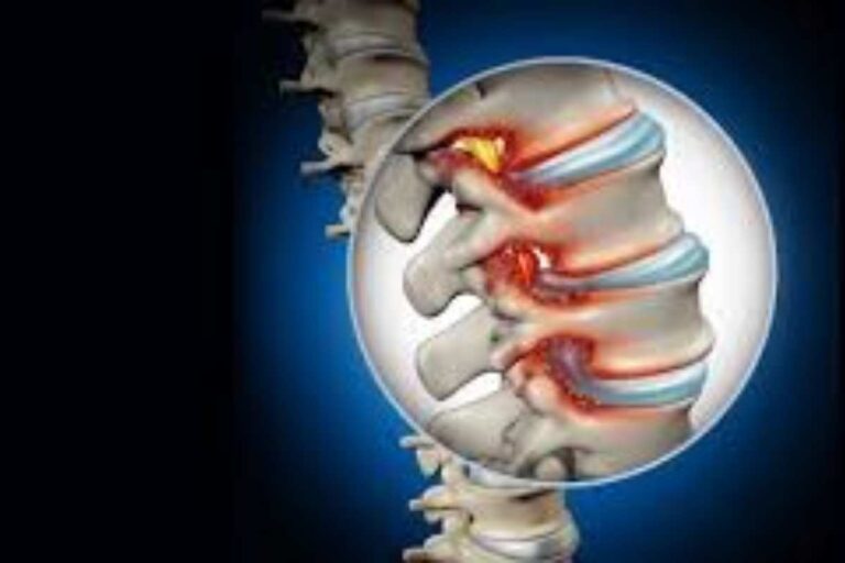 What Treatments Are Available for Spinal Stenosis? Complete Relief Guide