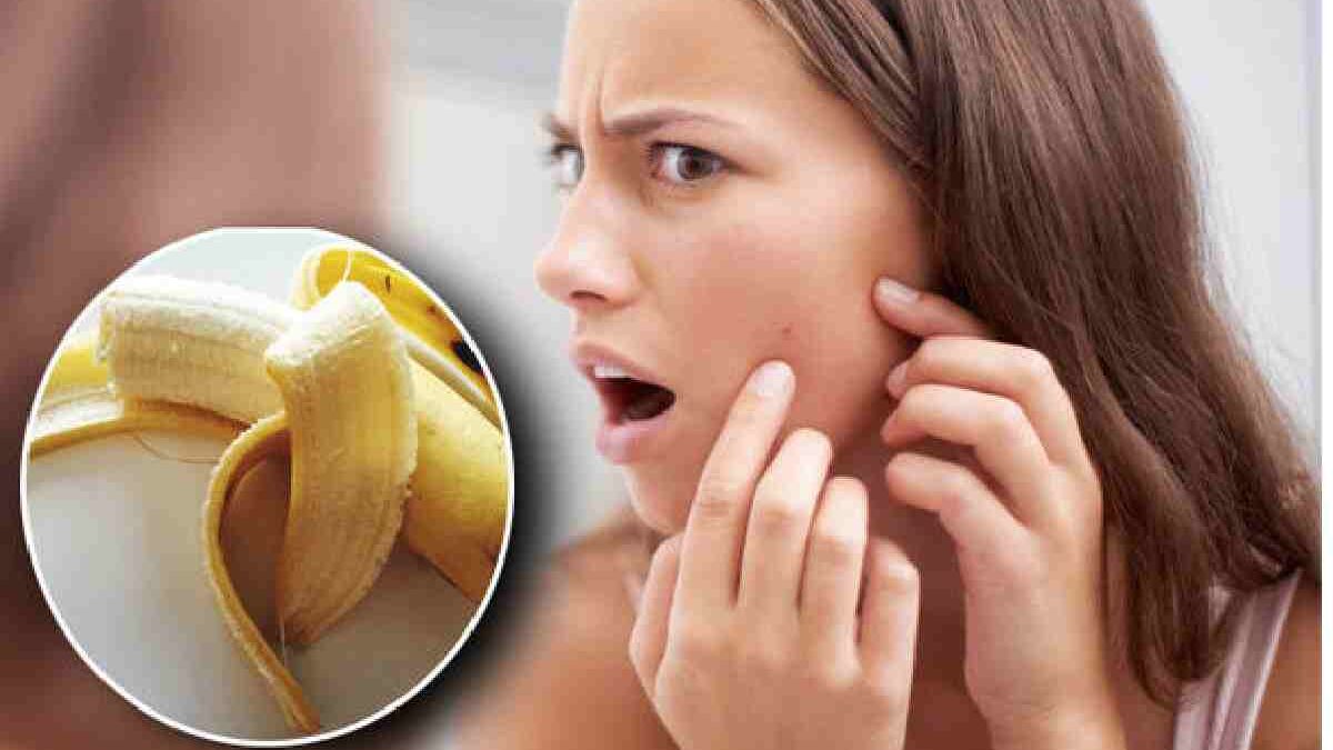 Bananas for acne – Properties, Benefits of banana peels for your skin