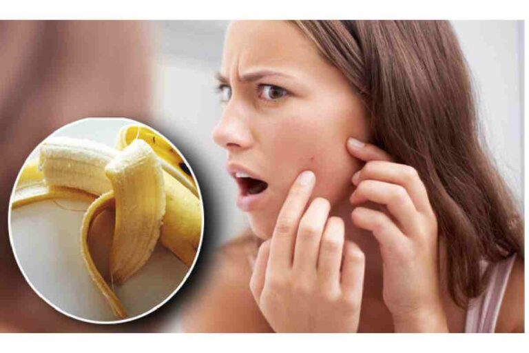 Bananas for acne – Properties, Benefits of banana peels for your skin