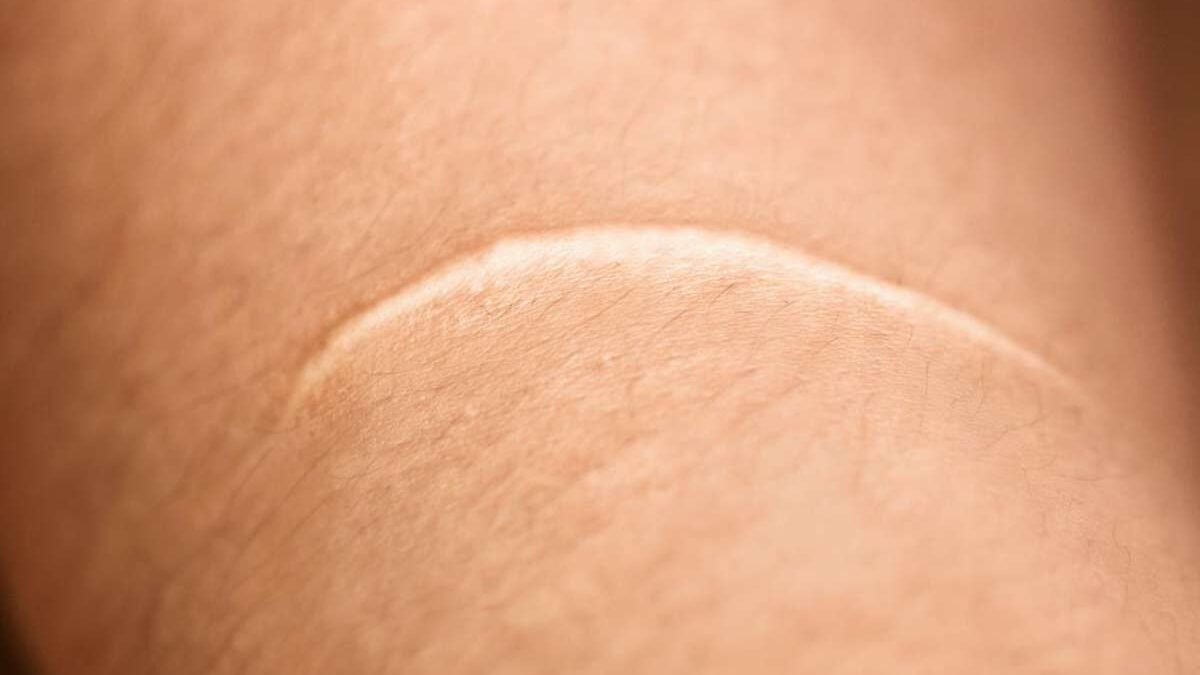 Interesting Facts About Keloids