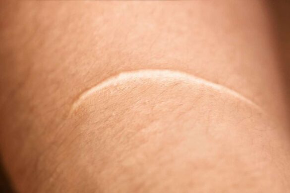 Keloids