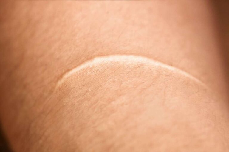 Interesting Facts About Keloids