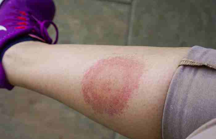 Verschleppte Borreliose-Symptome (1)