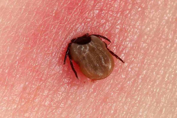 Verschleppte Borreliose-Symptome