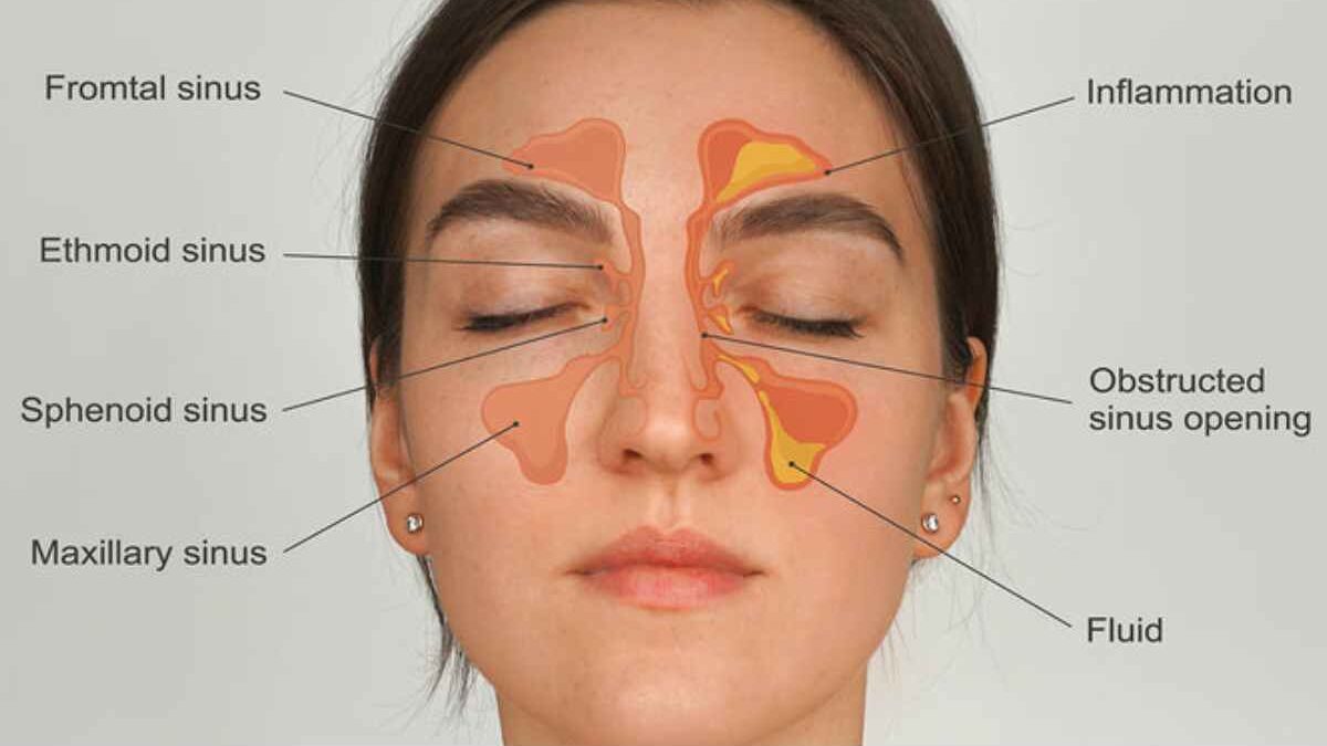 Can Sinus Infections Be Contagious?