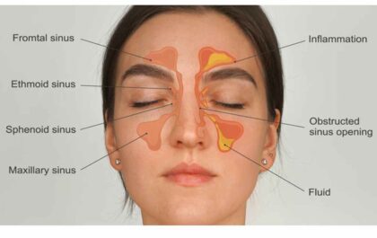 Can Sinus Infections Be Contagious_