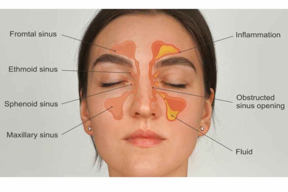 Can Sinus Infections Be Contagious_