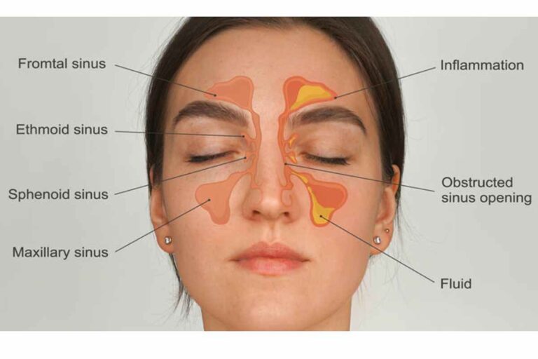 Can Sinus Infections Be Contagious?