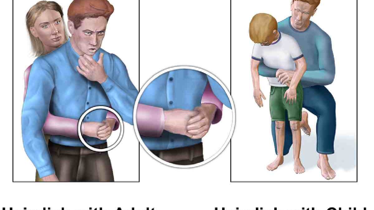 The Heimlich Maneuver: A Life-Saving Technique for Choking Emergencies