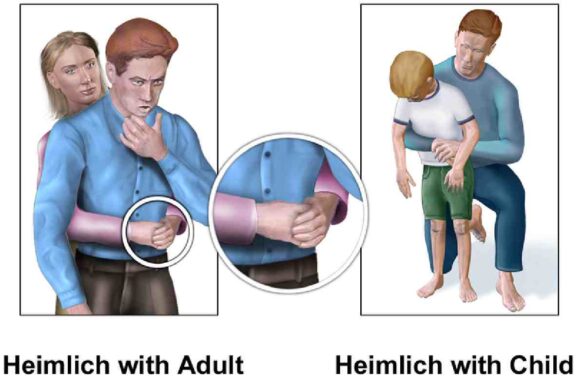 Heimlich Maneuver