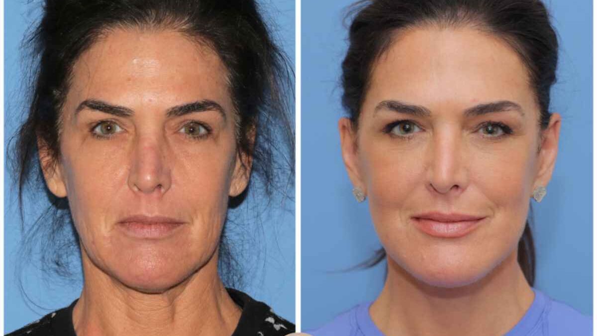 How Does Facial Reshaping Differ from a Facelift