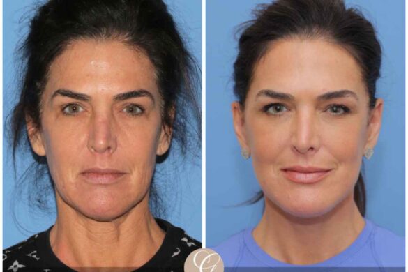 How Does Facial Reshaping Differ from a Facelift_