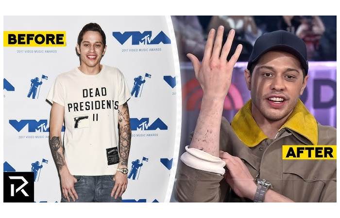 Pete Davidson Tattoo Removal (1)