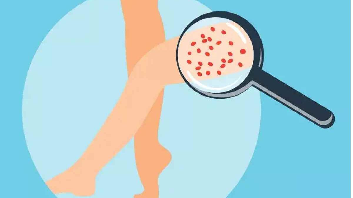 How to Get Rid of Strawberry Skin? : Top Treatments Revealed