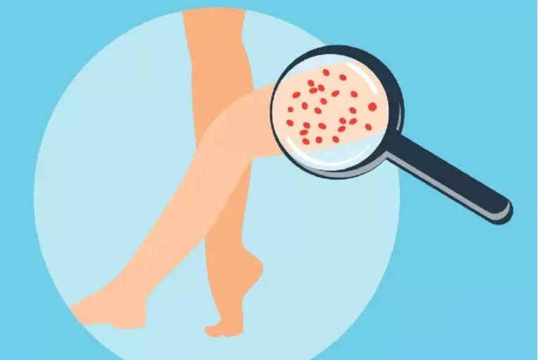 How to Get Rid of Strawberry Skin? : Top Treatments Revealed